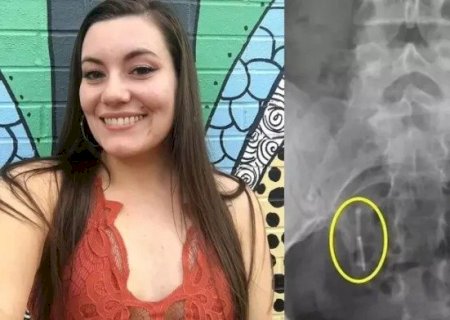 MULHER ENCONTRA DIU NO RETO; ITEM ESTAVA ‘PERDIDO’ HÁ 12 ANOS DENTRO DE SEU CORPO