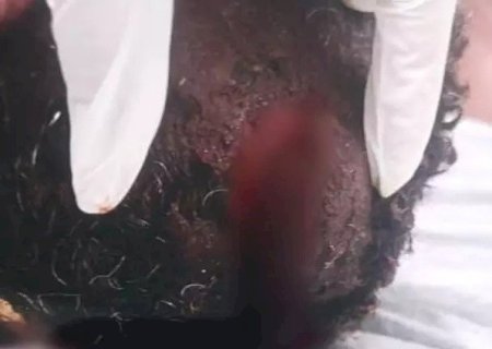MORRE HOMEM QUE TEVE MÃO AMPUTADA E CABEÇA 'RACHADA' PELA ESPOSA