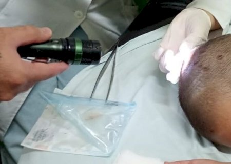 EM DOURADOS, CRIANÇA COM LARVAS NA CABEÇA SERÁ INTERNADA PARA TRATAMENTO NO HU